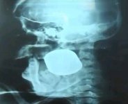 Из черепа мексиканки удалили неразорвавшуюся гранату