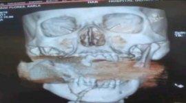 Из черепа мексиканки удалили неразорвавшуюся гранату